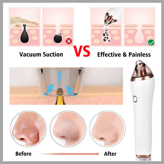 4-in-1 Facial & Body Blackhead Remover Device